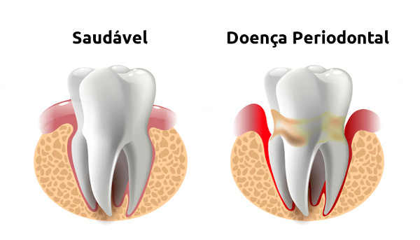 Dente saudável e dente doente