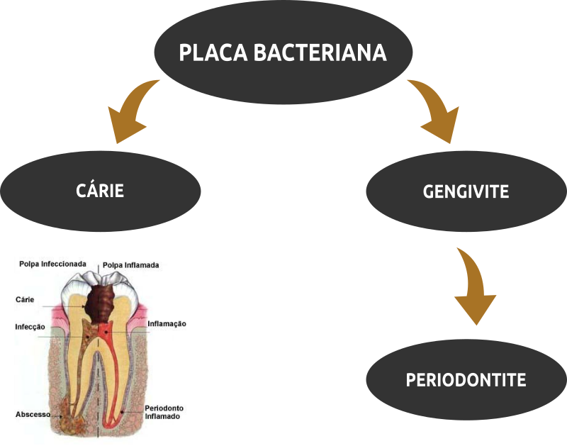 Consequencias da placa bacteriana